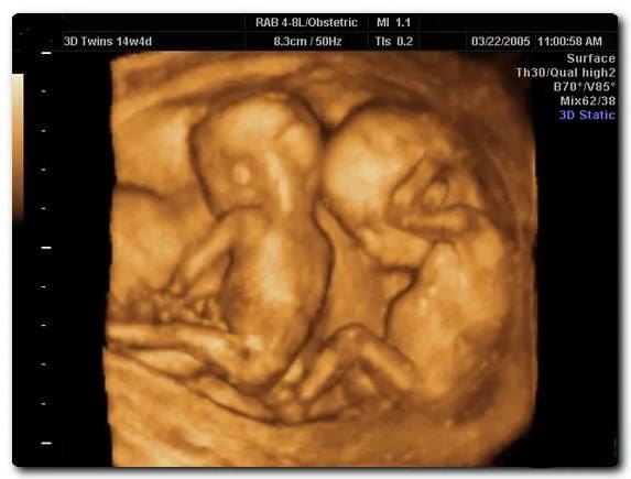 Многоплодная беременность